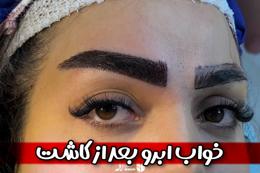 خواب ابرو بعد از کاشت | چرا این‌قدر مهم است؟