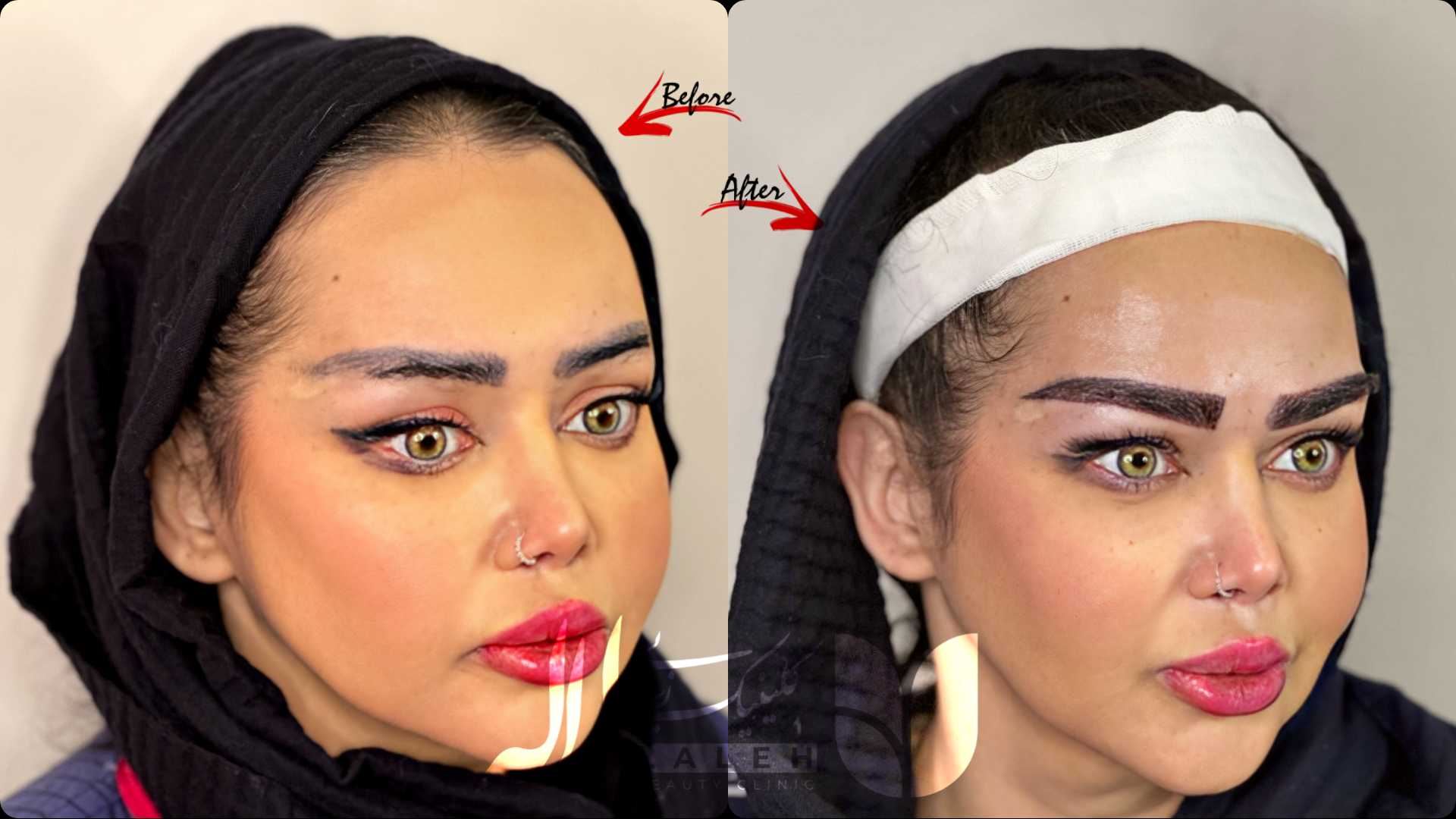 ماندگاری کاشت ابرو - برسی عوامل تاثیرگذار