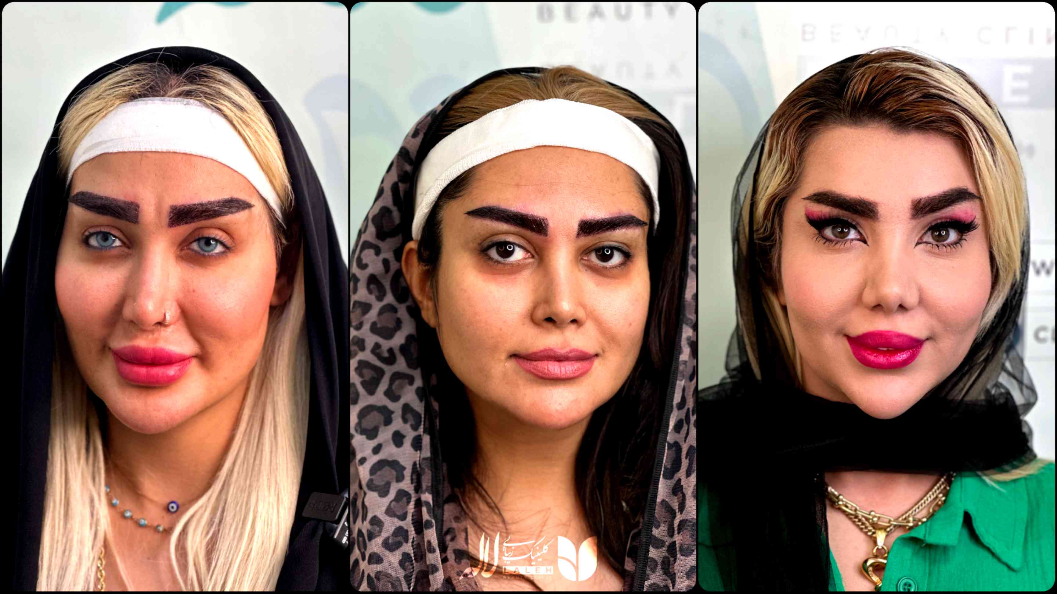 کاشت ابرو به سبک لیفت