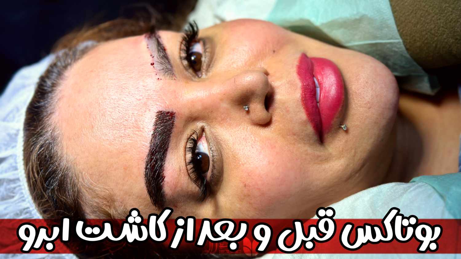 ایا بعد از کاشت ابرو میتوان بوتاکس انجام داد؟