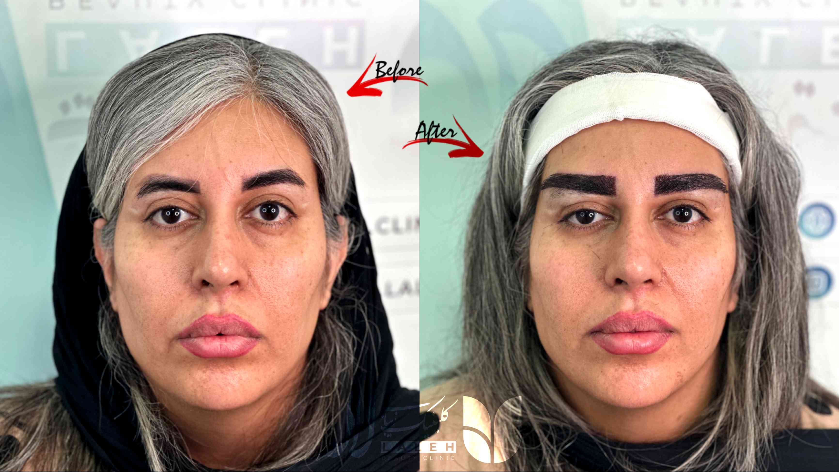 کاشت ابرو با موی سفید