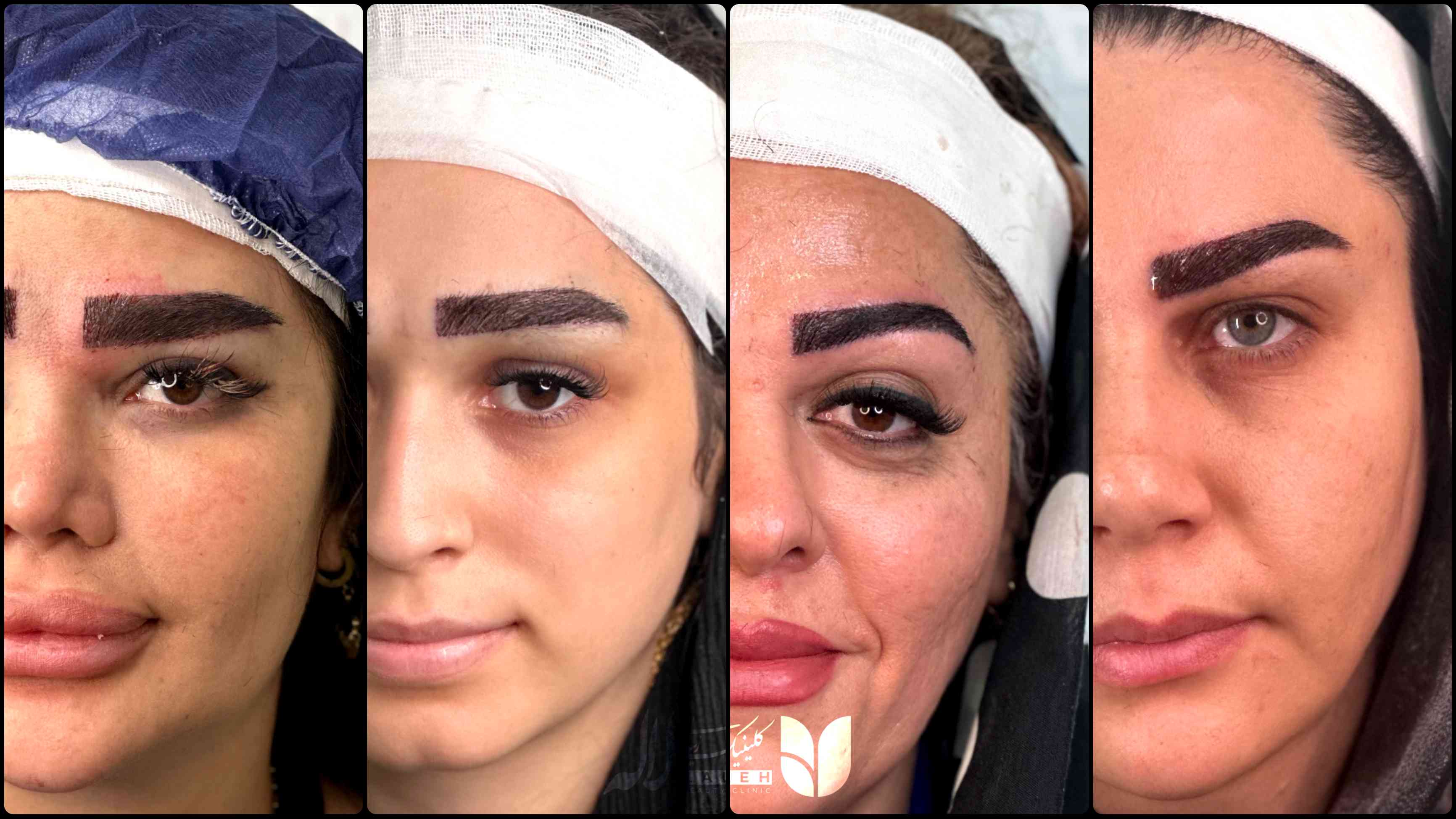 کاشت ابرو تا چه سنی جواب میده؟