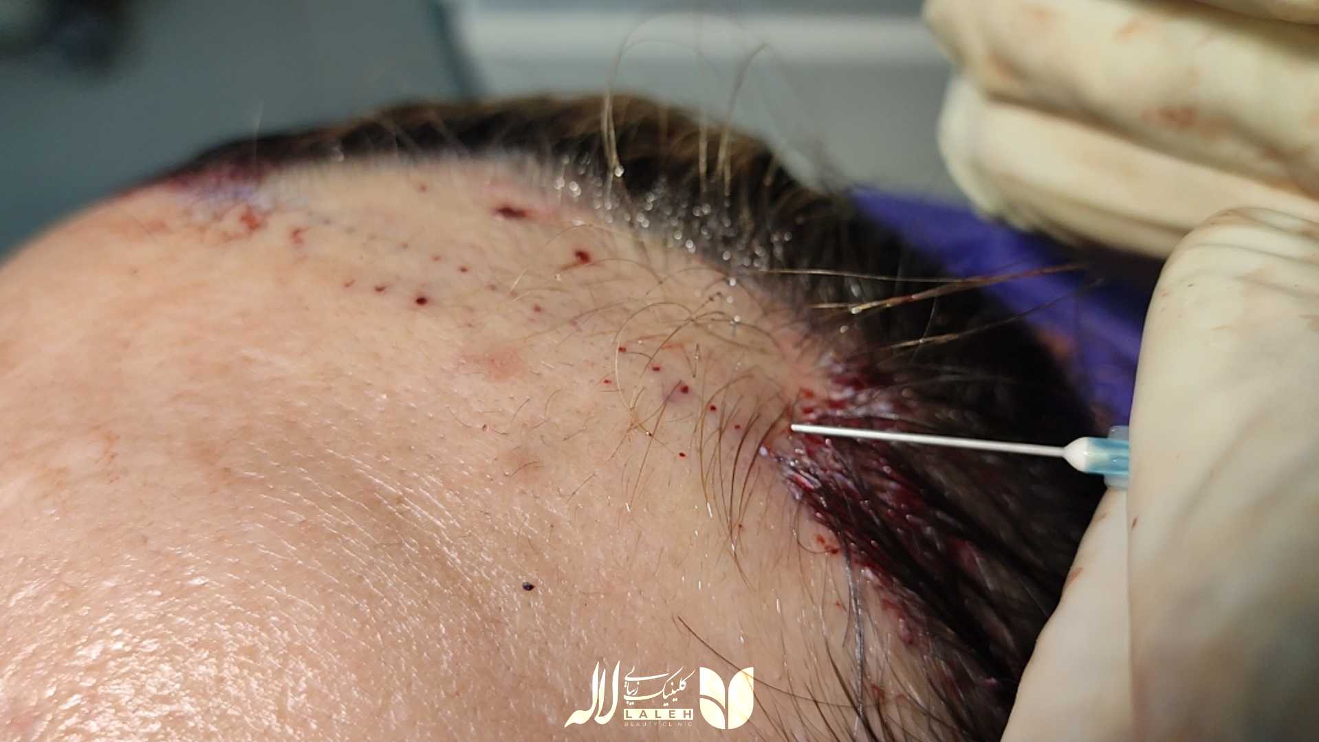 علت ریزش مو در سنین پایین