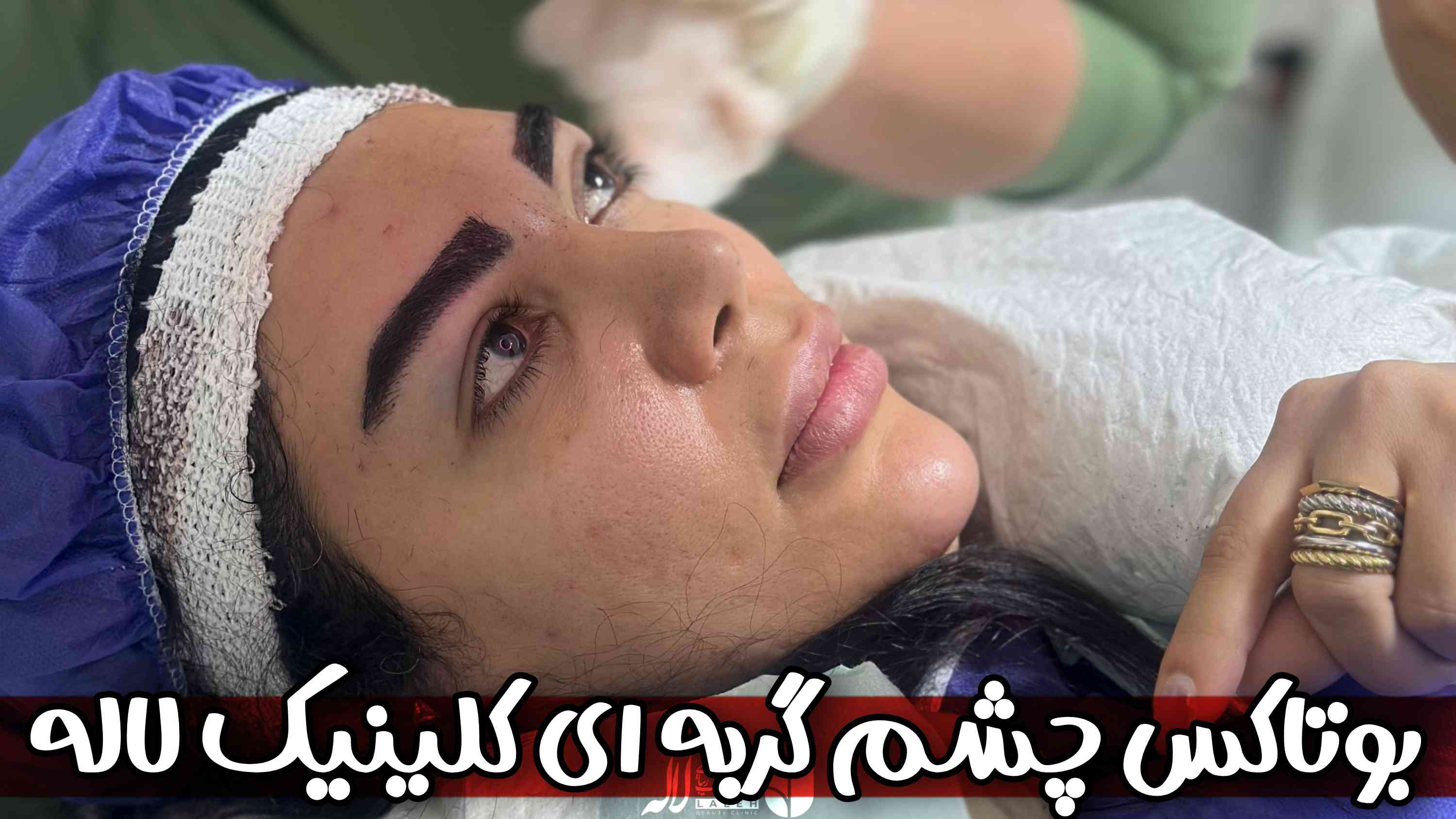 بوتاکس چشم گربه ای