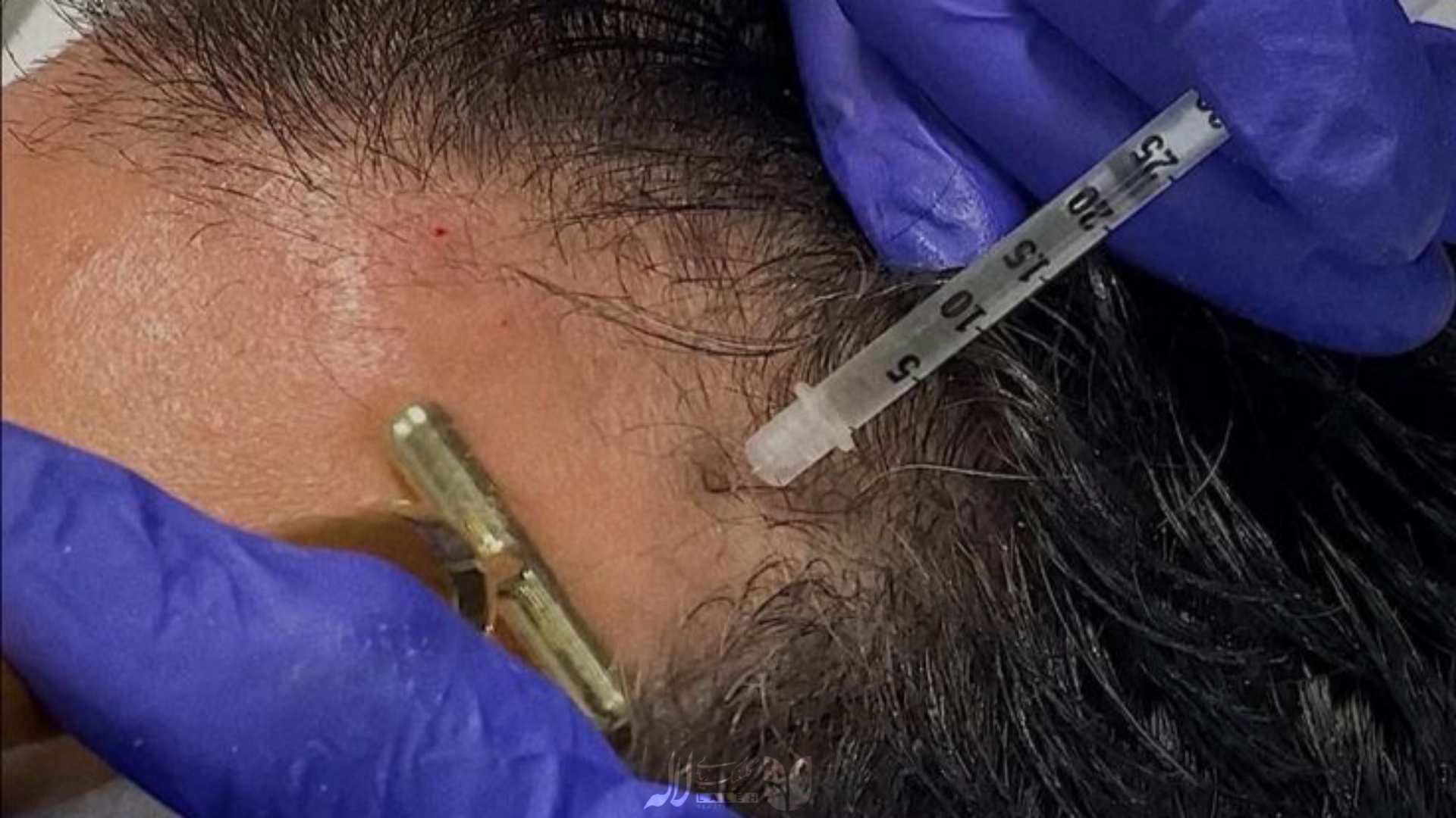 بهترین راهکار برای جلوگیری از ریزش مو