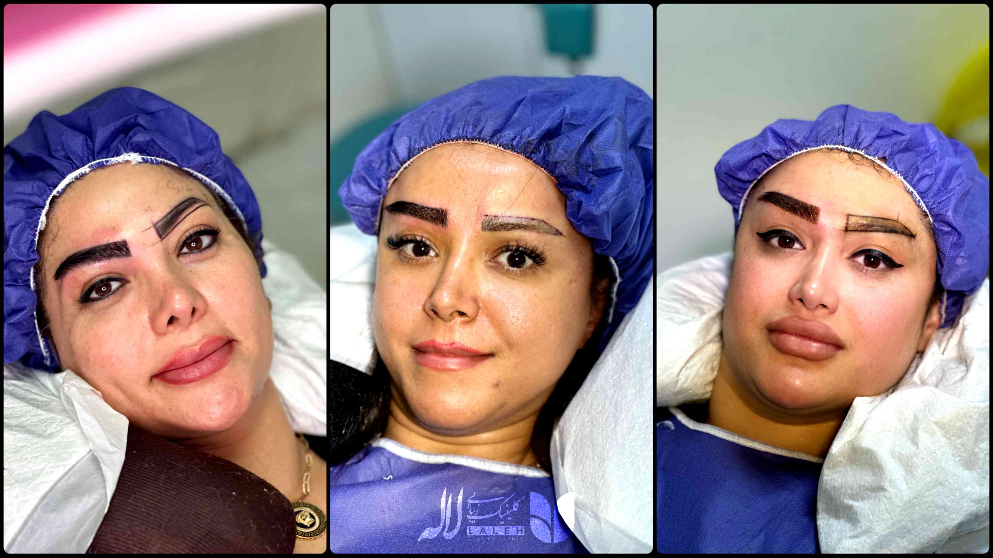 نحوه خوابیدن بعد از کاشت ابرو