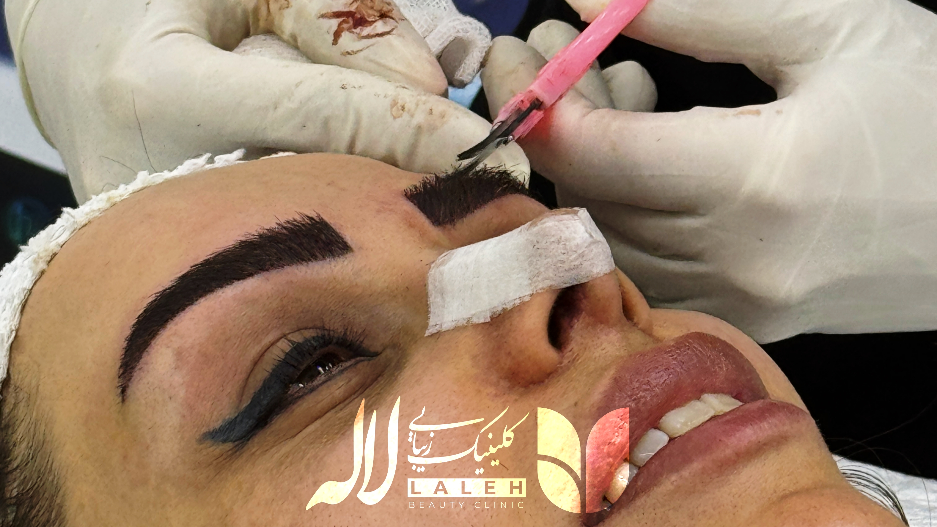 بهترین سن برای کاشت ابرو + ویدیو توضیحات پزشک