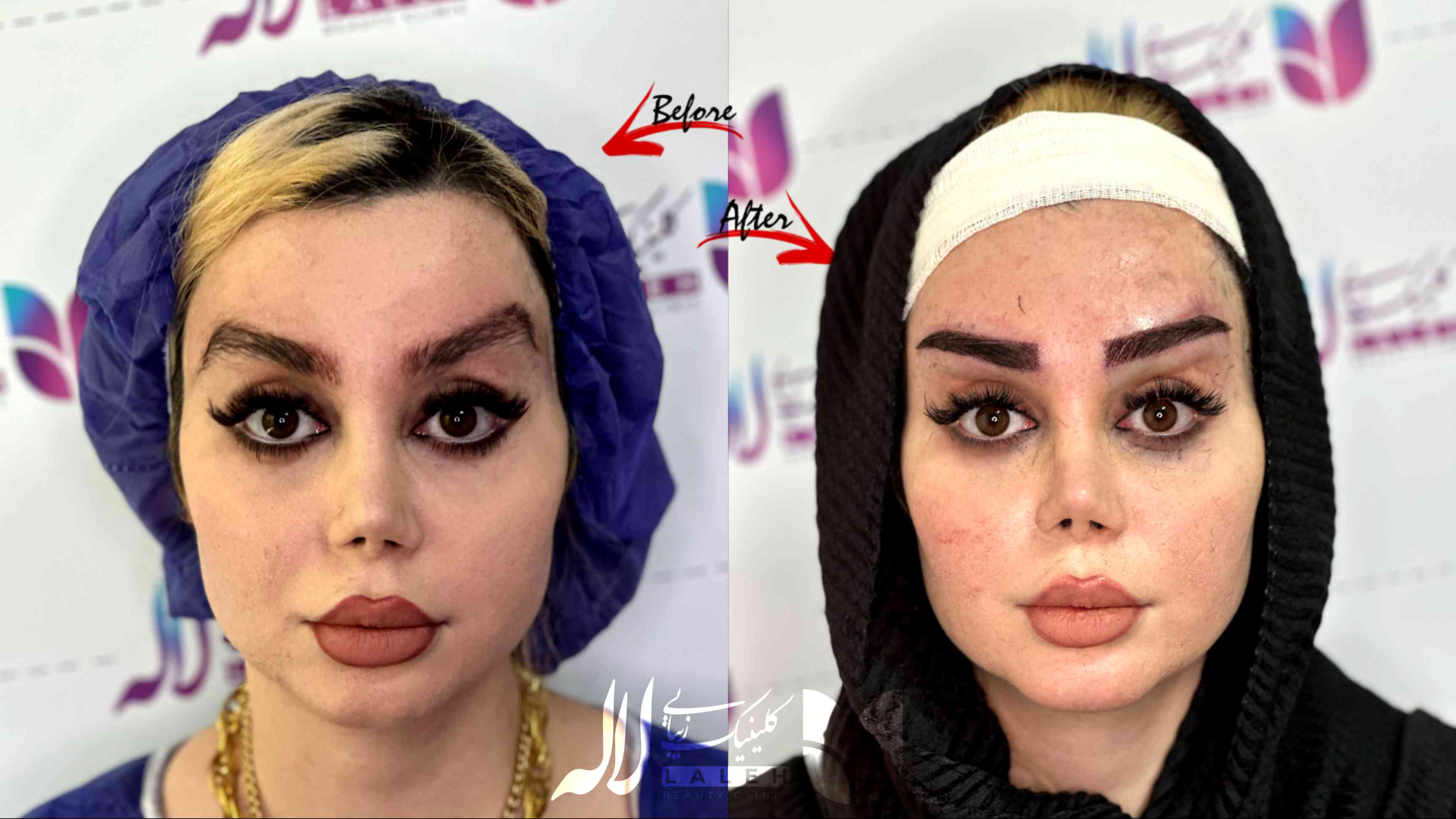 علت ریزش ابرو و راه های درمان