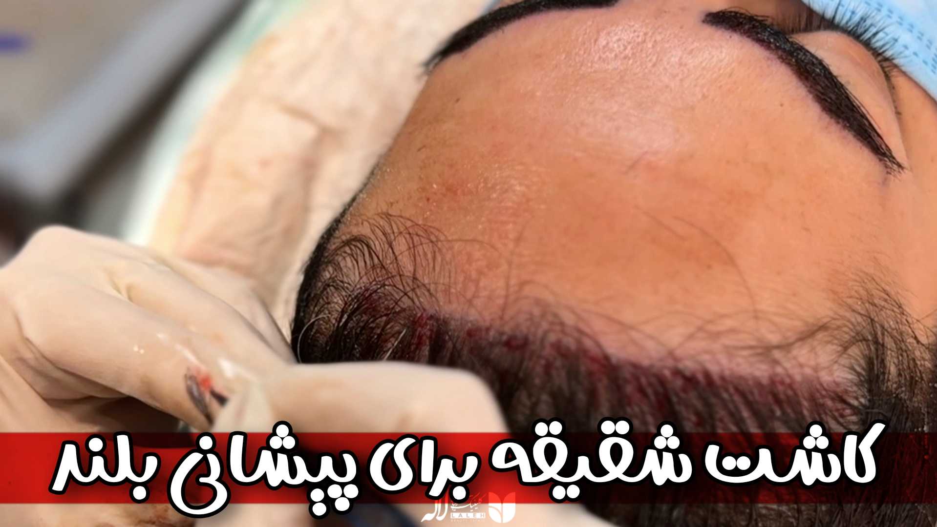 کاشت مو خانم ها - برسی جامع کاشت شقیقه بانوان