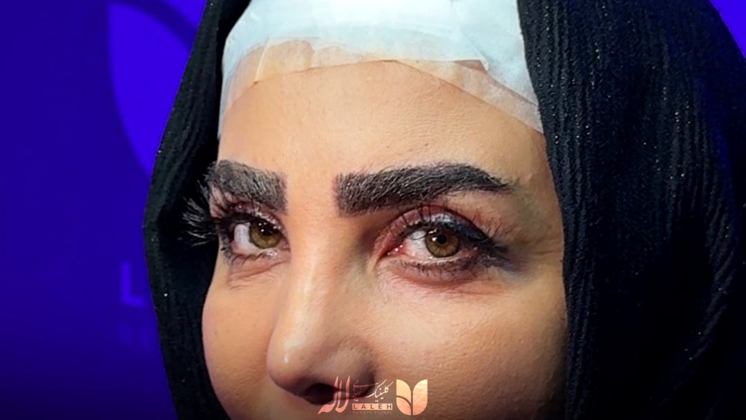 عوارض کاشت مژه طبیعی توسط پزشک - کاشت مژه دائمی