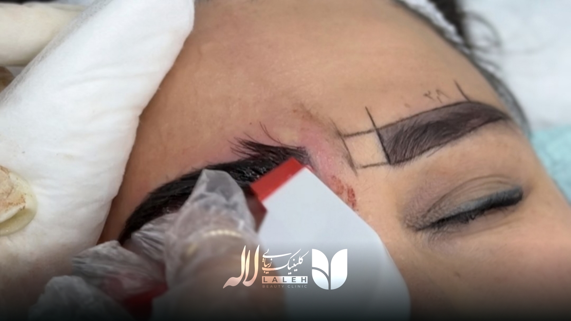 نحوه شستشوی ابرو بعد از کاشت + فیلم توضیحات توسط پزشک