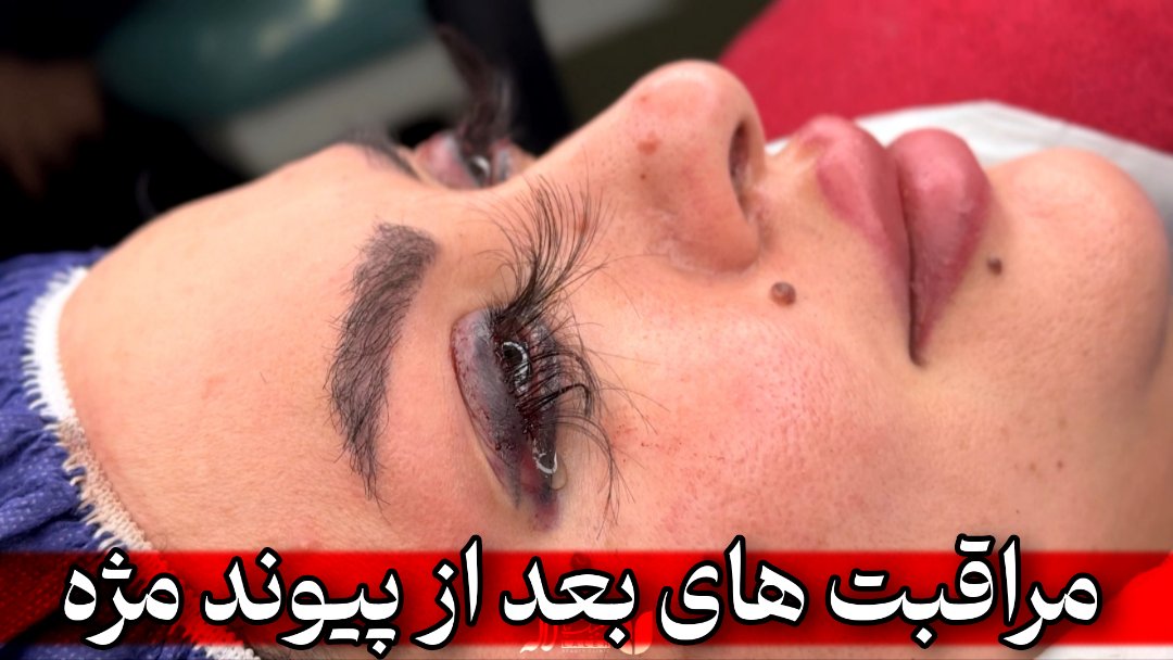 مراقبت های بعد از جراحی کاشت مژه