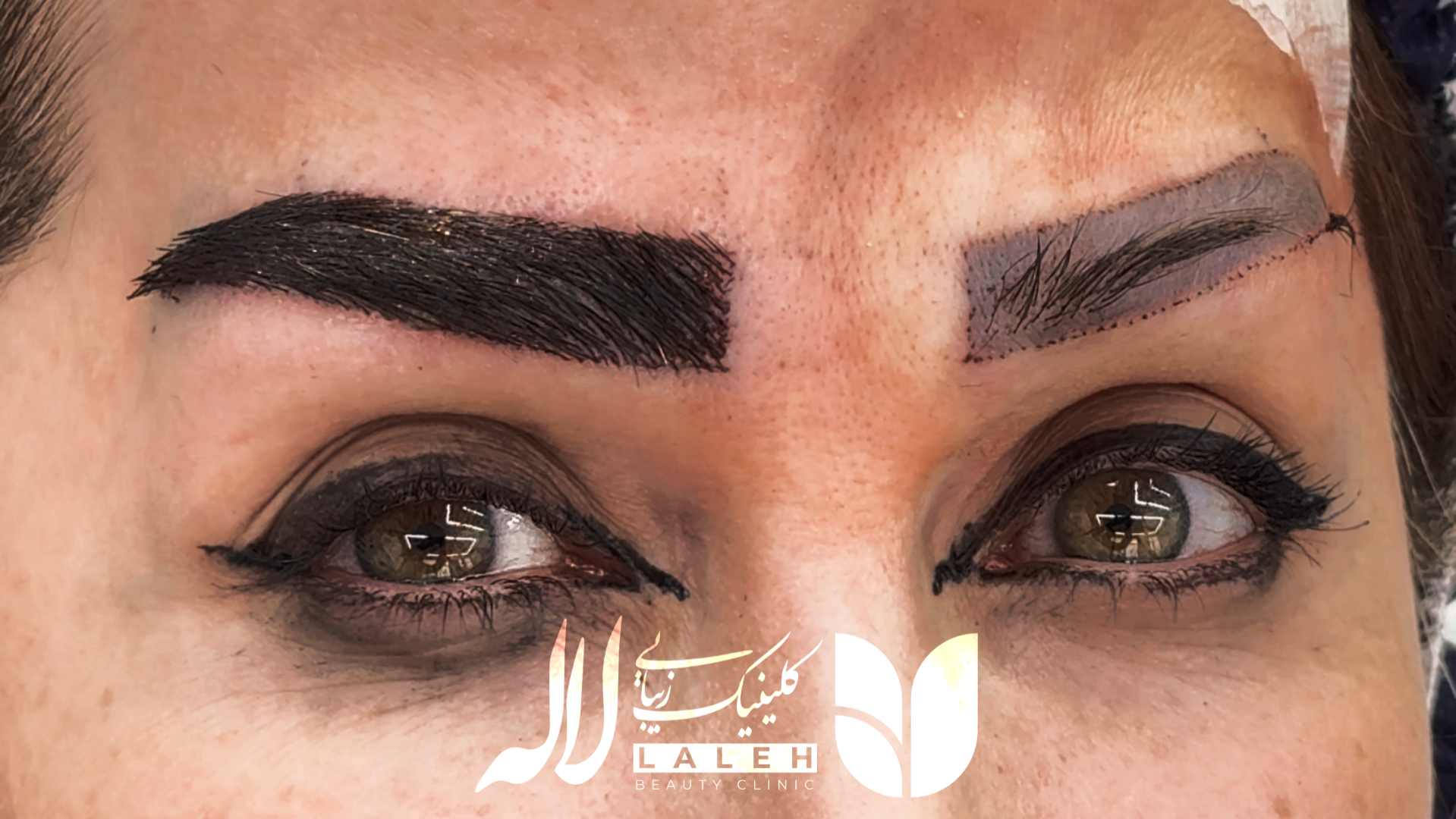 ضمانت نامه کاشت ابرو - برسی جامع ضمانت نامه کتبی