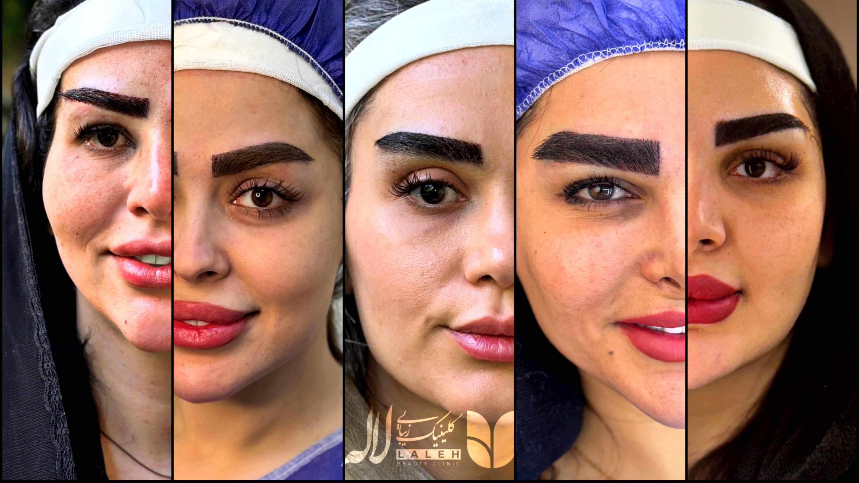 سوالات متداول کاشت ابرو