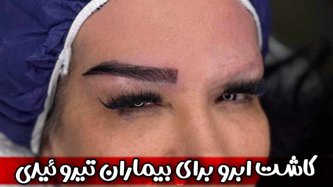 کاشت ابرو برای بیماران تیروئید | راهنمای کامل و جامع