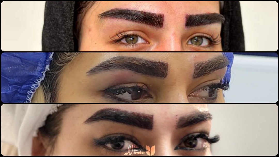 کاشت ابرو پهن - معرفی بهترین مرکز کاشت ابرو ایران