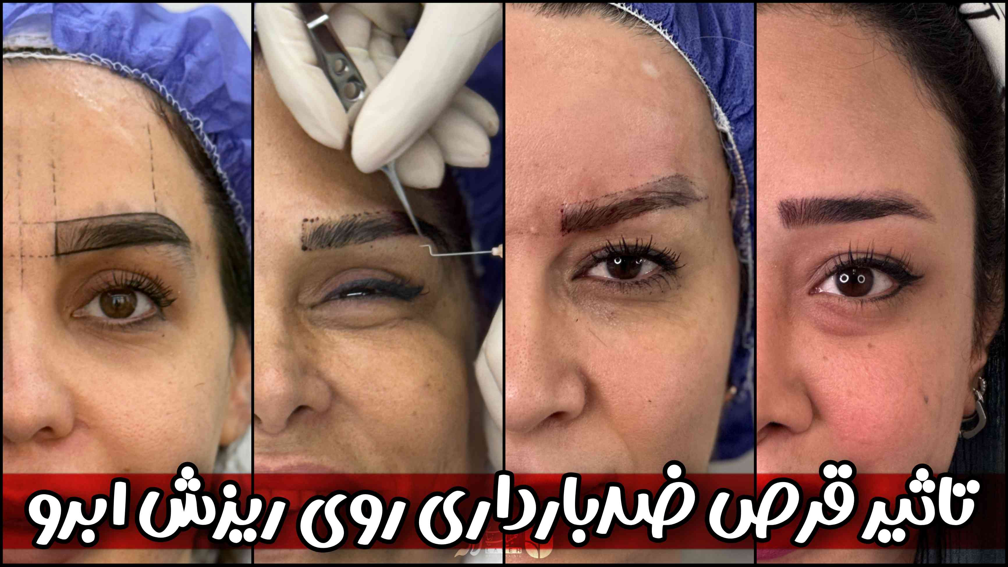 قرص ضدبارداری باعث ریزش ابرو میشه؟