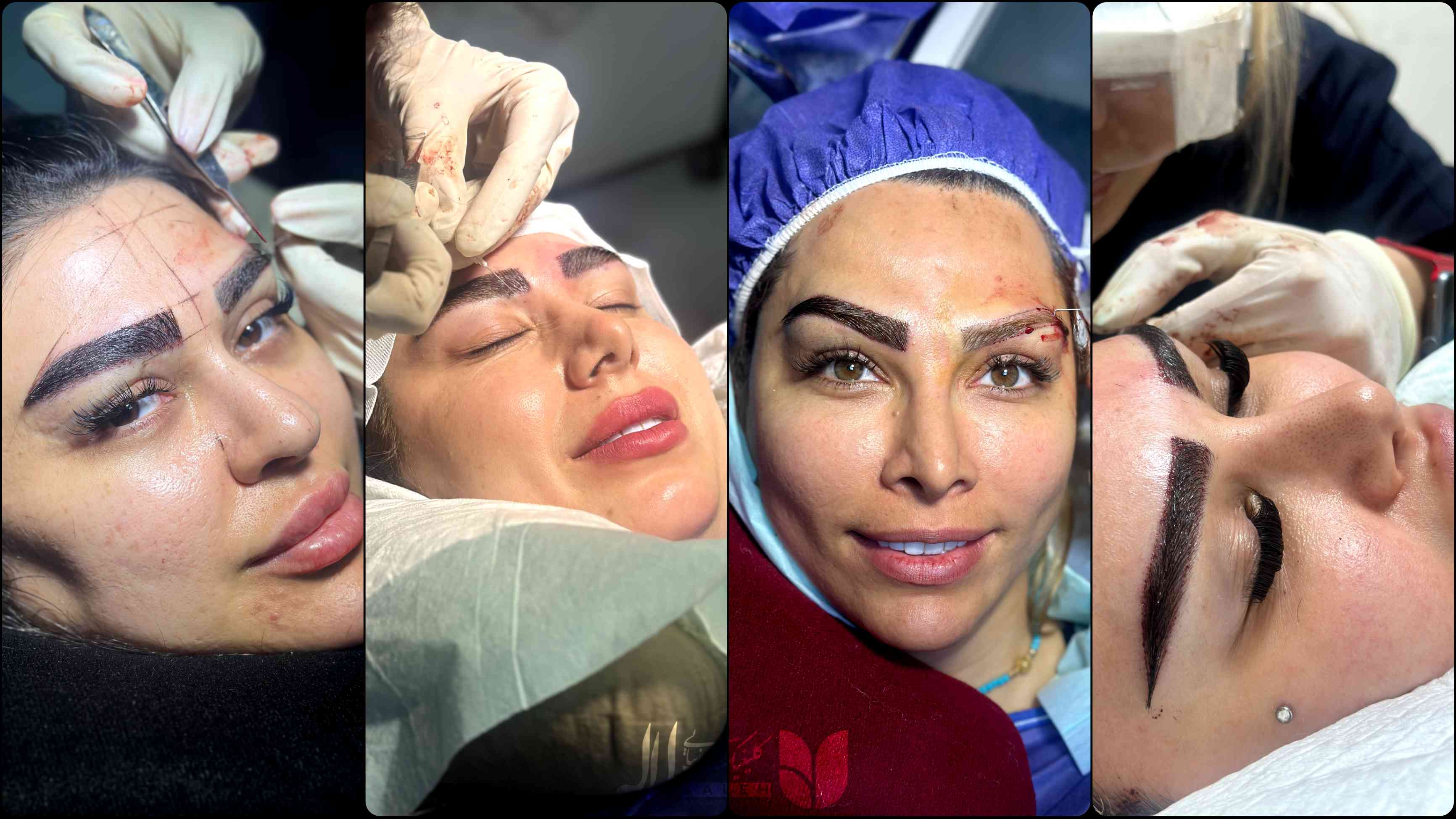 بهترین داروها برای تقویت ابرو کاشت شده