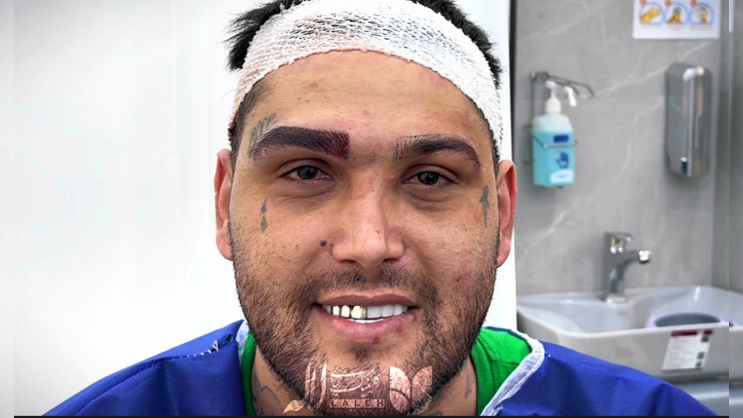 کاشت ابرو آقایان - معرفی مدل های مختلف ابرو مردانه