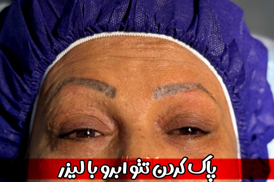لیزر پاک کردن تتو ابرو | راهنمای کامل برای انتخاب بهتر