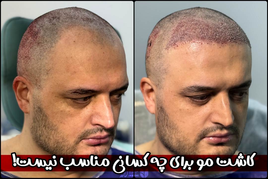 کاشت مو برای چه کسانی مناسب نیست؟ | بررسی تخصصی کاشت مو در تهران