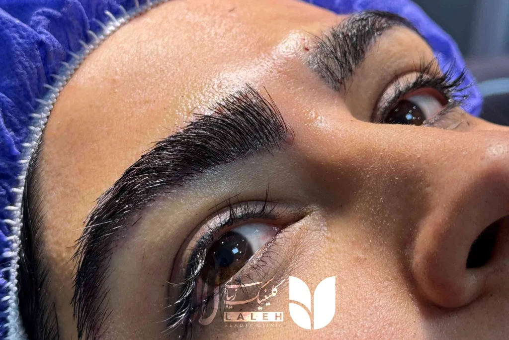 علت ریزش ابرو بعد از کاشت - معرفی جامع دلیل ریزش ابرو