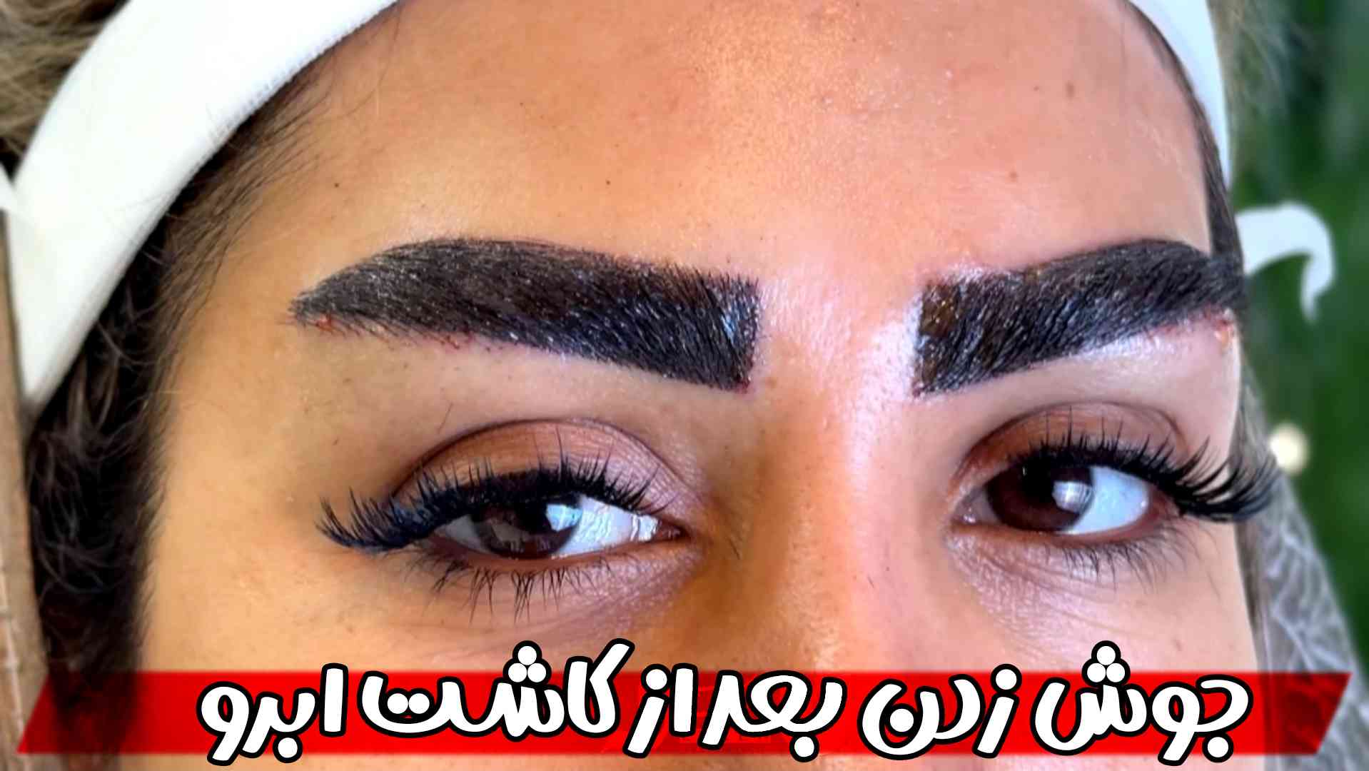 علت ایجاد جوش بعد از کاشت ابرو