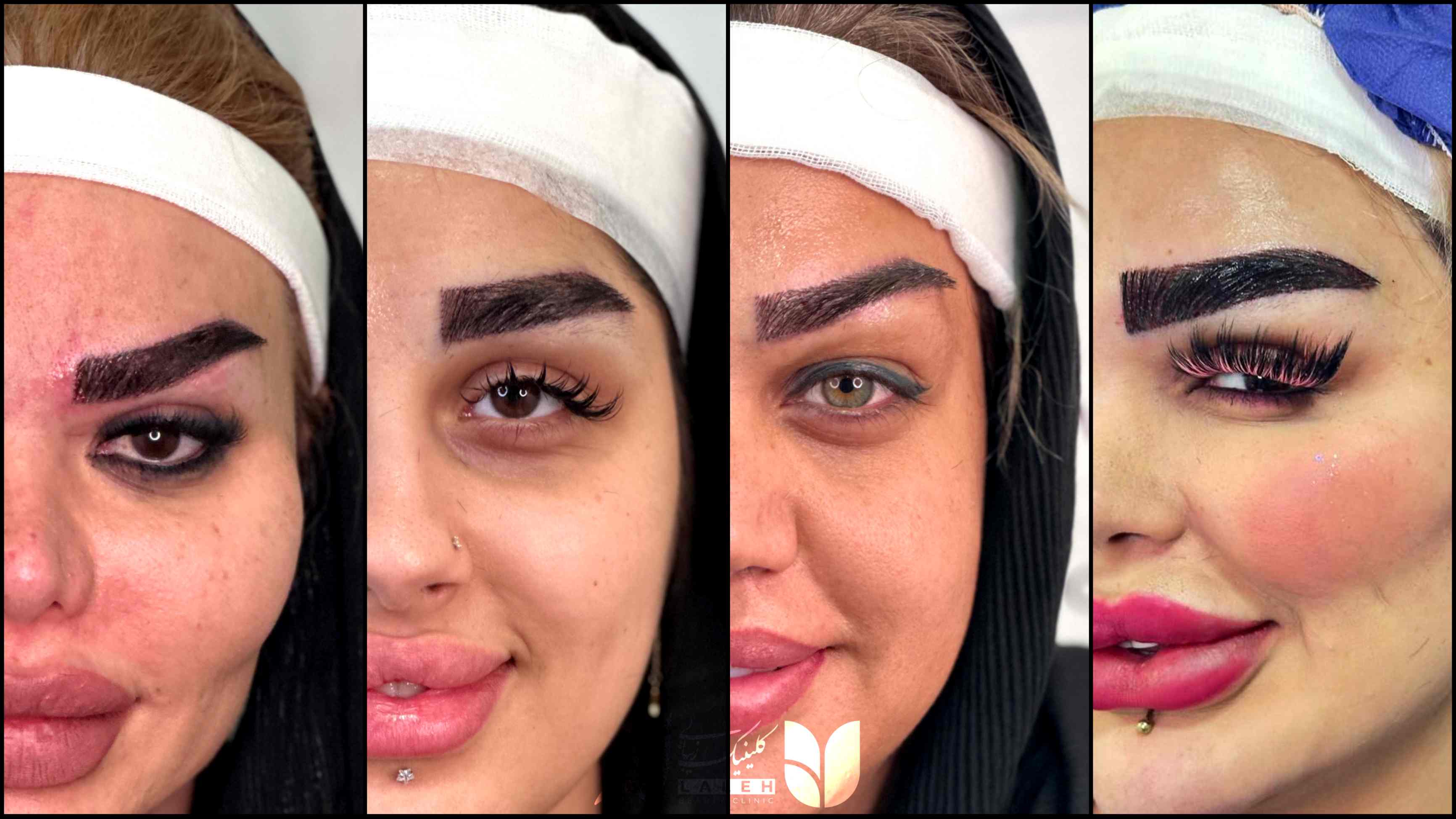 همه چیز راجع به کاشت ابرو + فیلم کامل کاشت ابرو