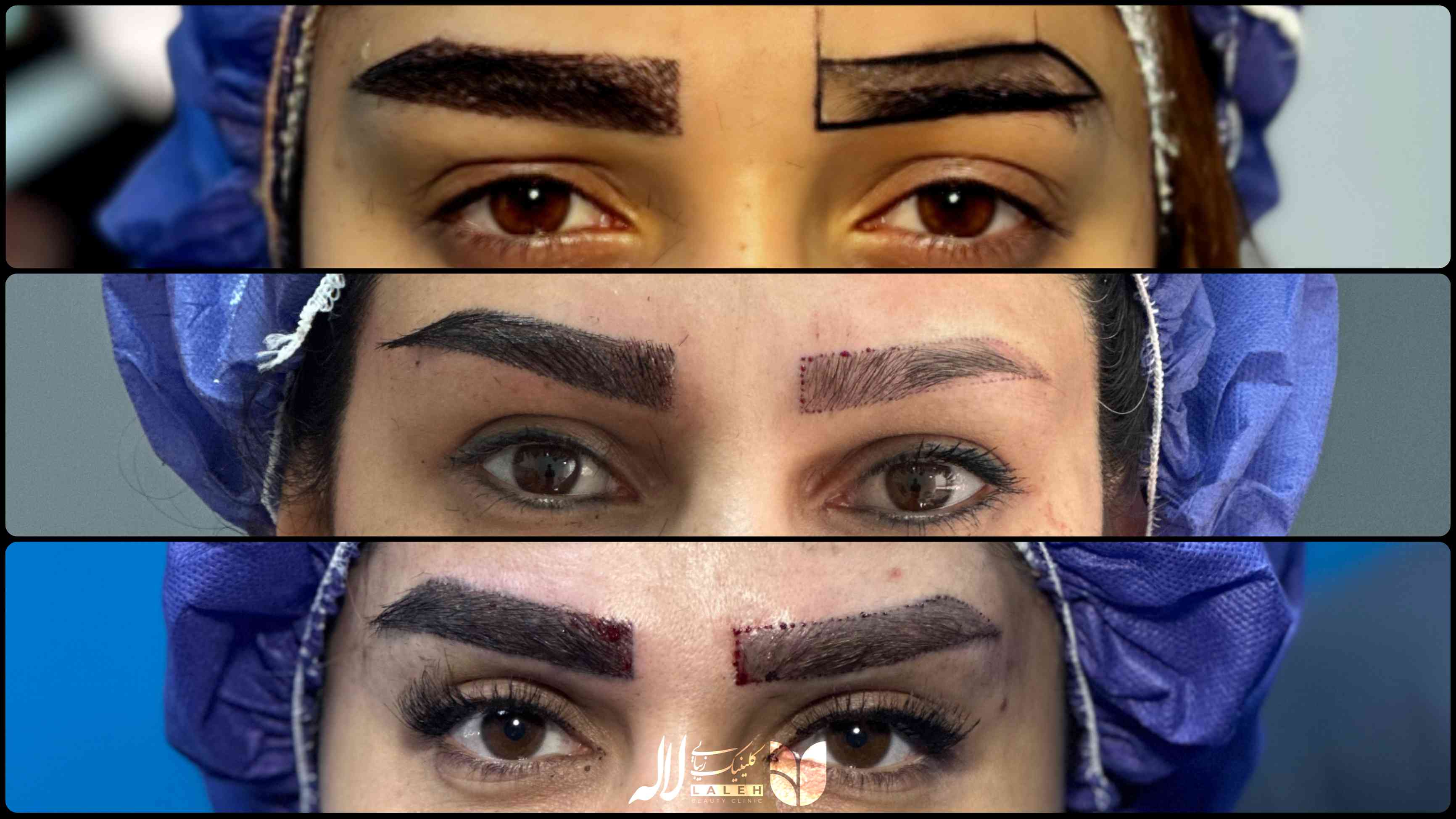 کاشت ابرو یا میکروبلیدینگ؟ - برسی جامع مزایا و معایب