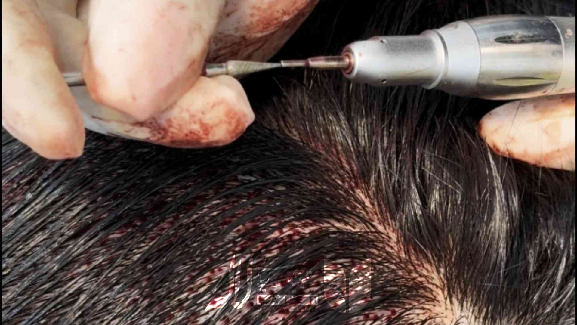 برای کاشت ابرو از کجا مو برداشته میشه؟