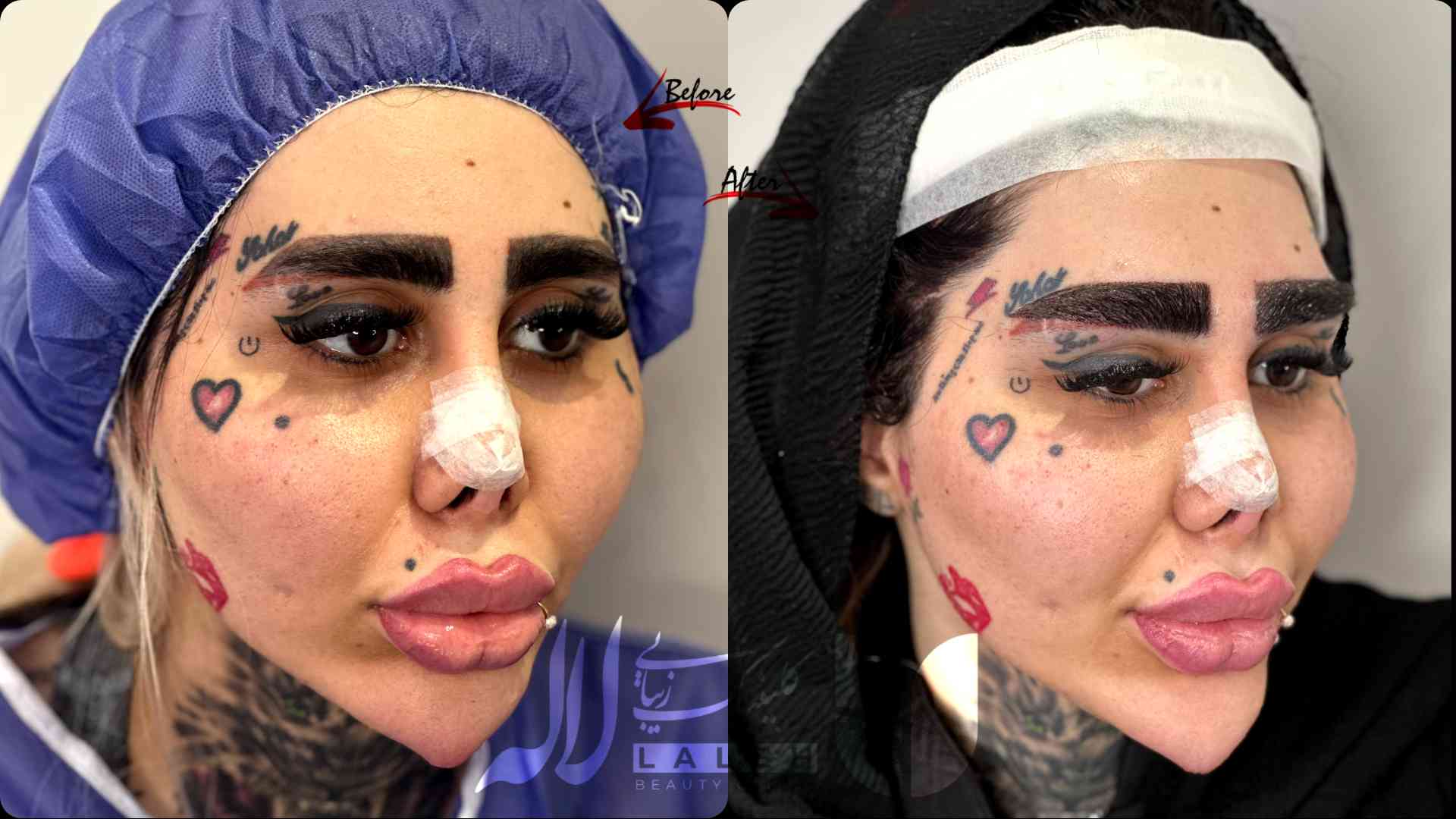 عوارض کاشت ابرو - معرفی تمام عوارض رایج بعد از کاشت