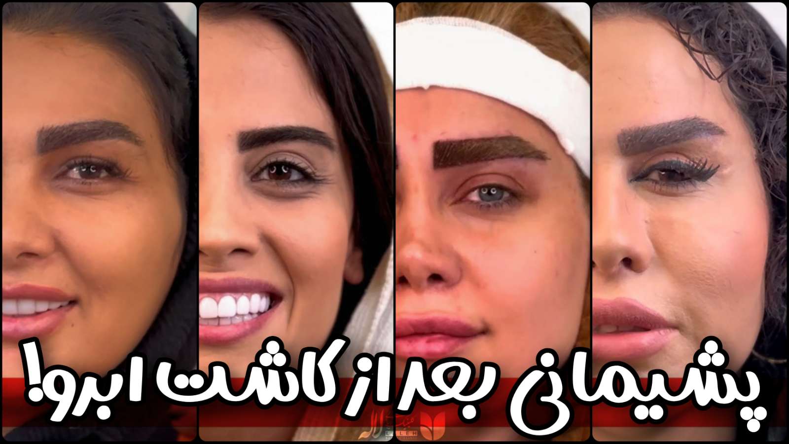 پشیمانی از کاشت ابرو - برسی کلی علت پشیمانی