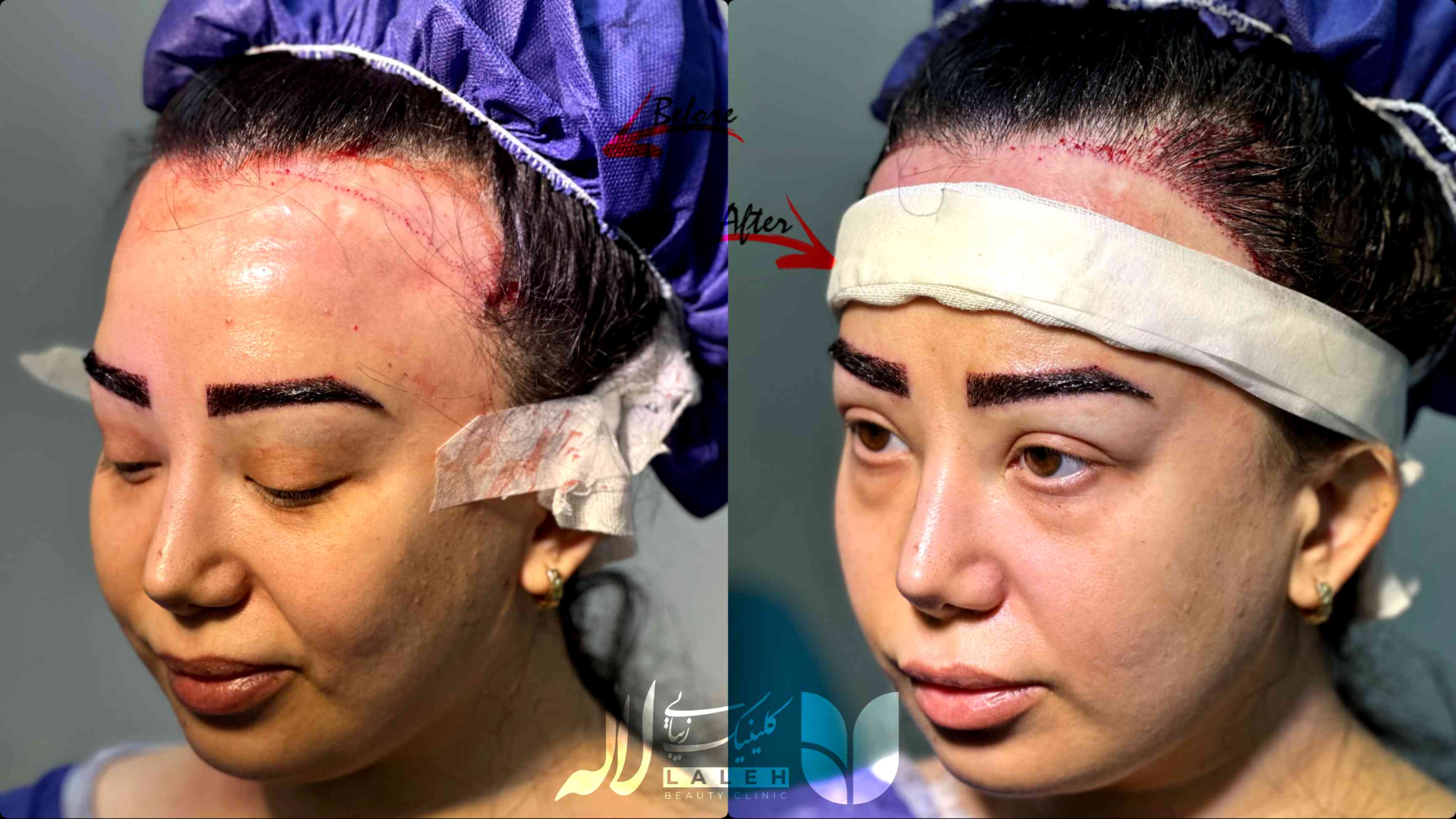 کاشت مو بانوان - تکنیک جدید بدون نیاز به تراشیدن سر