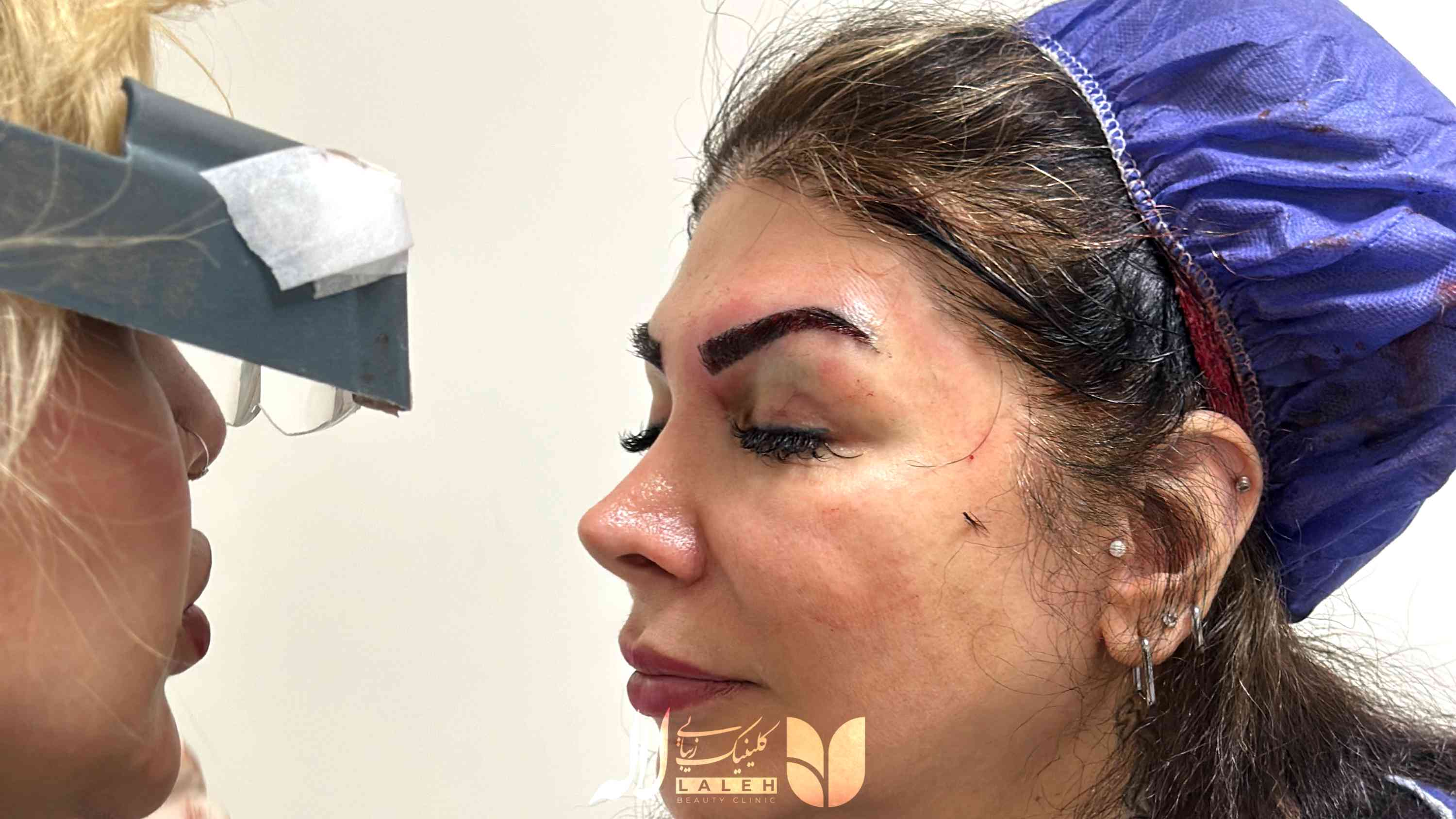 دلایل سیخ شدن ابروها بعد از کاشت - معرفی راه حل درمان