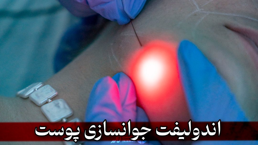 اندولیفت - برسی جامع معایب و مزایا