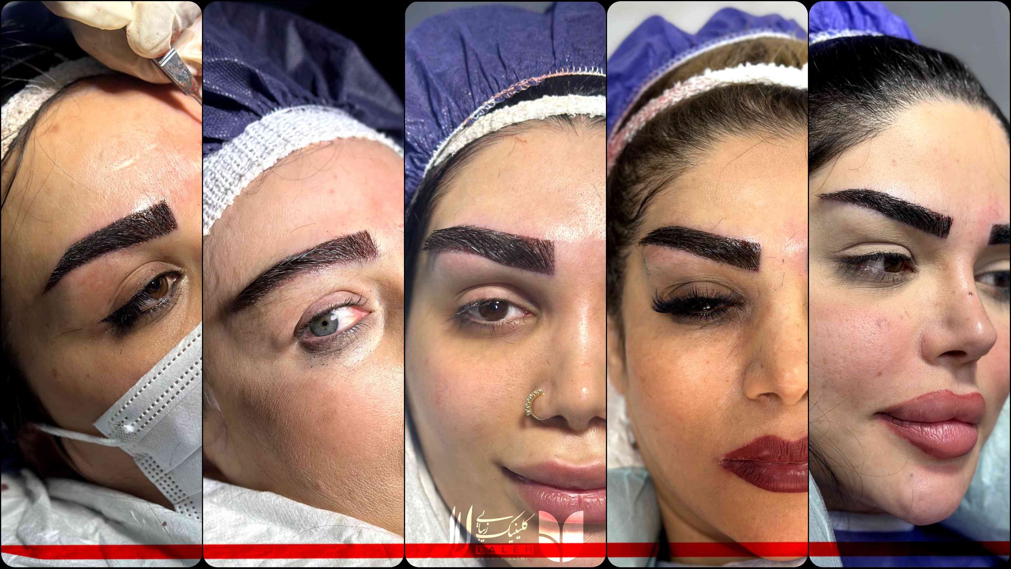 بعد از کاشت ابرو بانک مو دوباره رشد میکنه؟