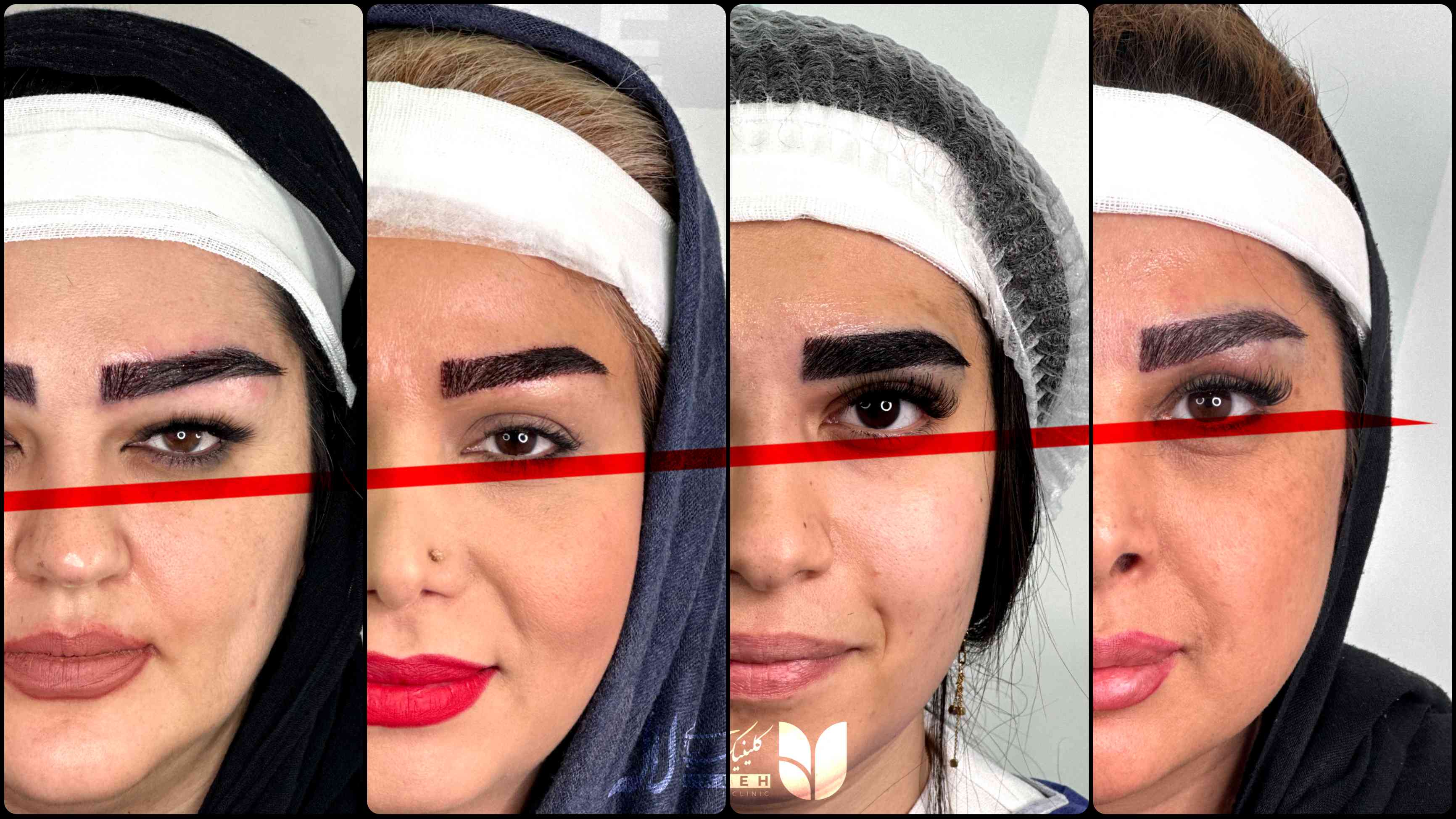 کاشت ابرو چقدر زمان می‌برد؟