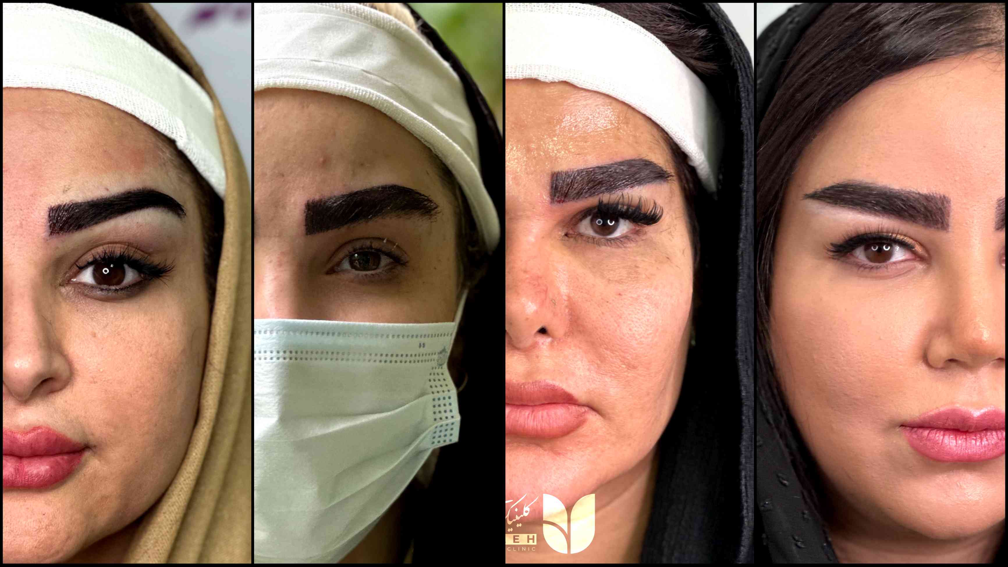 کاشت ابرو روی تاتو امکان پذیر است؟